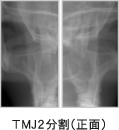 TMJ2分割（正面）